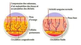 traitement-cellulite